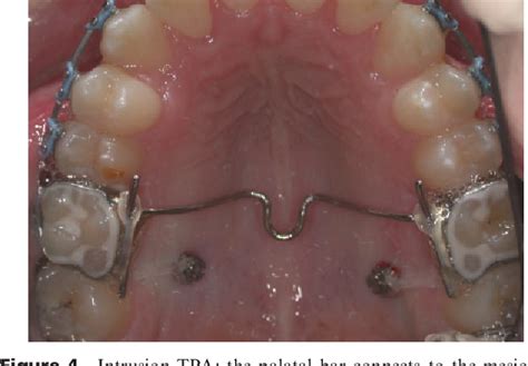 Figure From A Clinical Strategy For Maxillary Molar Intrusion Using Orthodontic Miniimplants