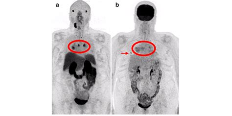 The Exploration Of Psma Pet As A Possible Theranostic Agent In Thyroid