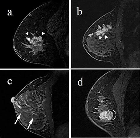 Descriptors Of Malignant Non Mass Enhancement Of Breast Mri Their Correlation To Clinical