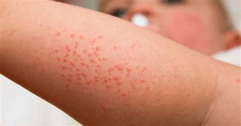 Dermatite Atópica Em Crianças Conheça As Causas Sintomas E Tratamentos