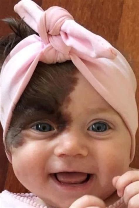 Pin By Shanti On Babies Beautiful Children Unique Faces Birthmark