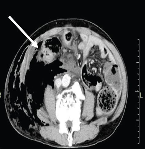 Radiological Findings A Abdominal Contrast Enhanced Computed