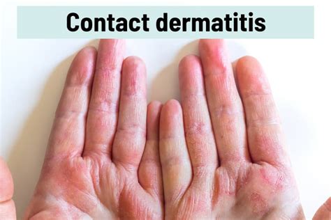 Skin Peeling On Fingertips 15 Causes Pictures And Treatments