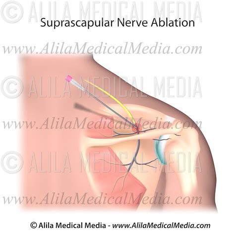 Suprascapular Nerve Radiofrequency Ablation Alila Medical Images