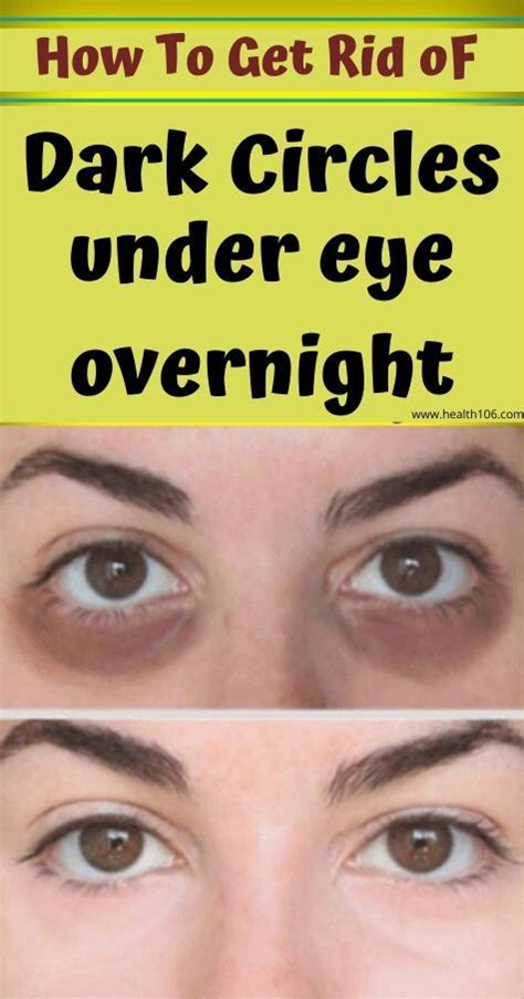 11 Best Home Remedies For Overnight Remove Dark Circles At Home 18