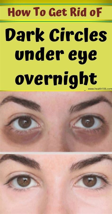 18 How To Get Rid Of Dark Circles Under Eye Ideas