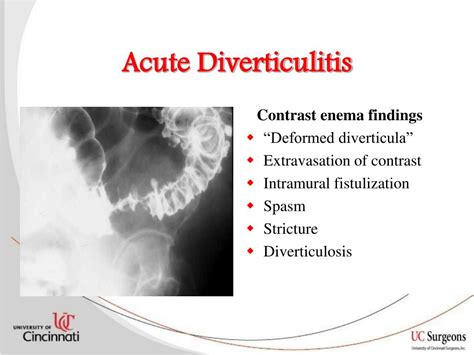 Ppt Practice Parameters For Sigmoid Diverticulitis Powerpoint Presentation Id6904856