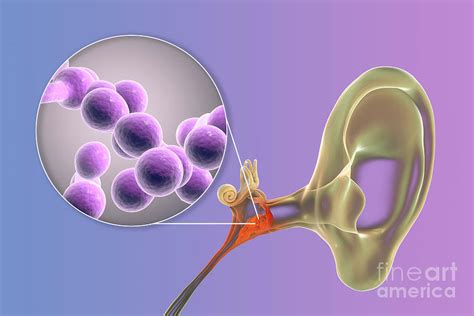 Chronic Fungal Otitis Media Ear Infection Photograph By Kateryna Kon