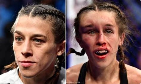 Incredible Before And After Pictures Show Battered And Bruised Ufc
