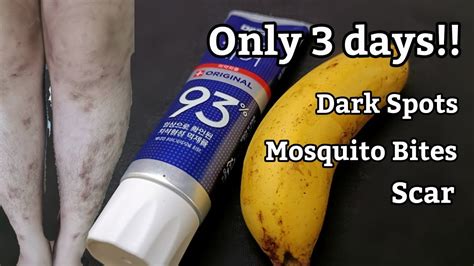 Only 3 Days How To Remove Mosquito Bites On Legs Scar Dark Spots