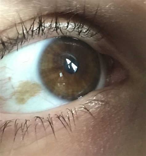 Brown Spot In My Eye Web Eye Clinic