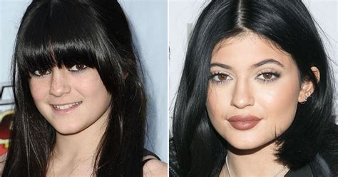 Kylie Jenners Lips See The Dramatic Transformation Of The Stars Pout