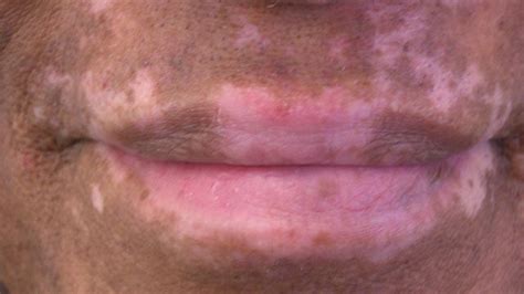 White Skin Discoloration Around Lips