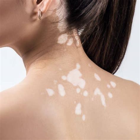 White Spots On Skin Nowmi
