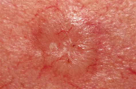 Skin Cancer Types Basal Cell Carcinoma Bcc Squamous C
