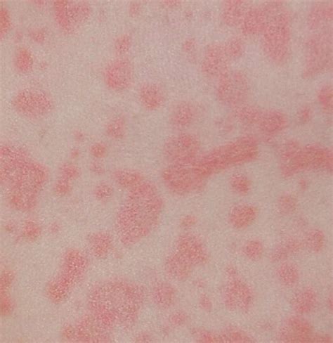 Collection 92 Images What Does A Rash From Amoxicillin Look Like Stunning