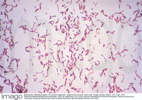 Actinomyces Viscosus Gram Stain Image Courtesy Cdc Dr W A Clark 1977
