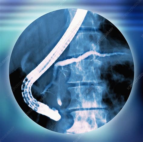 Pancreas Examination X Ray Stock Image F0012981 Science Photo