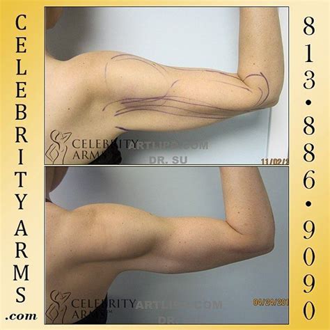 Revolutionary Celebrity Arms Liposuction Celebrityarmsliposuction