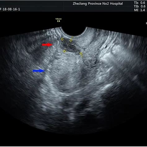 Transvaginal Ultrasound Picture Of A Sagittal View In B Mode Ultrasound