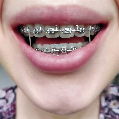 pin on braces and retainers orthodontics