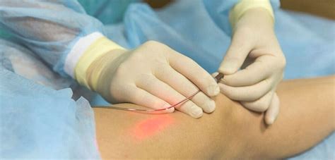 Endovenous Laser Ablation — Physicians Vein Clinics