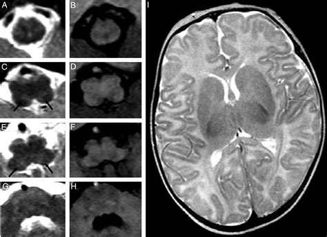 Dorsal Brain Stem Syndrome Mr Imaging Location Of Brain Stem Tegmental