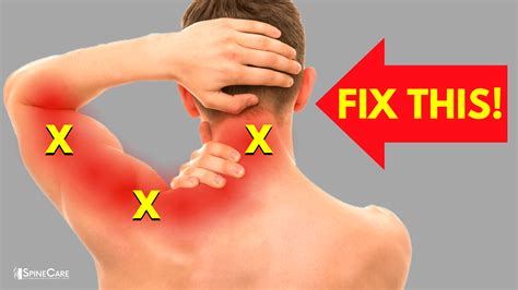 How To Instantly Relieve Nerve Pain In Your Neck And Arm Spinecare