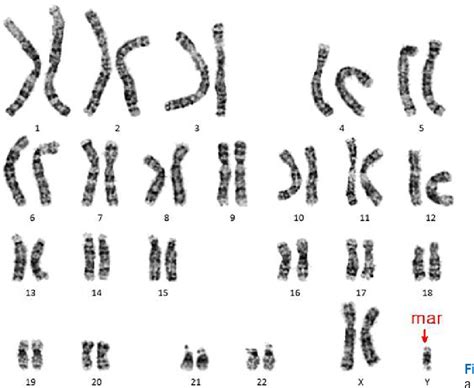 Figure 1 From Prenatal Diagnosis Of The Isodicentric Chromosome 22