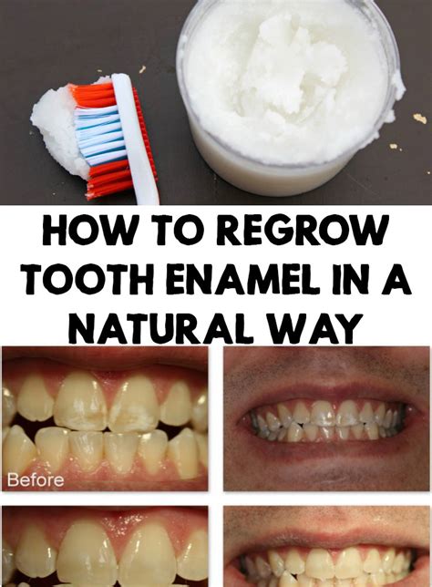 Dental crowns are also used to cover cracked teeth and strengthen weak teeth after injury. How To Regrow Tooth Enamel In a Natural Way - Fashion Daily
