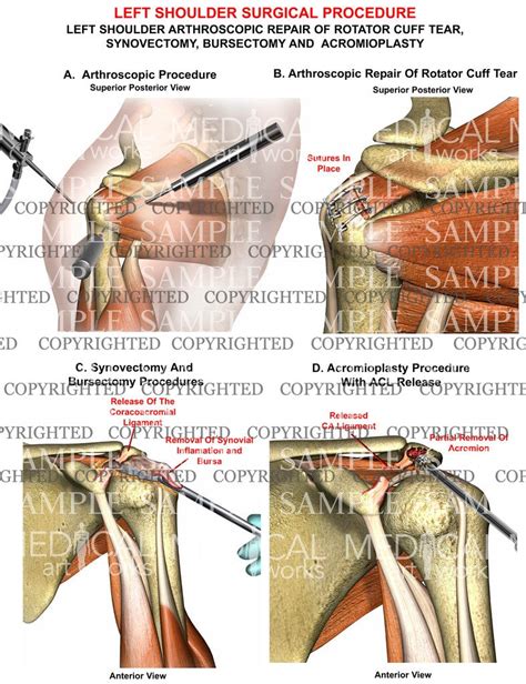 Left Shoulder Rc Synovectomy Bursectomy Acromiplasty Medical Art Works