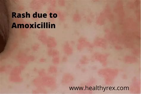 Can Amoxicillin Raise Your Blood Sugar