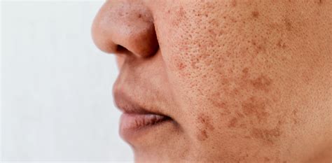 Sun Damaged Skin Treatments Mesa Az Sagebrush Dermatology