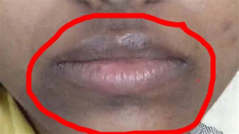 Dark Discoloration On Lips