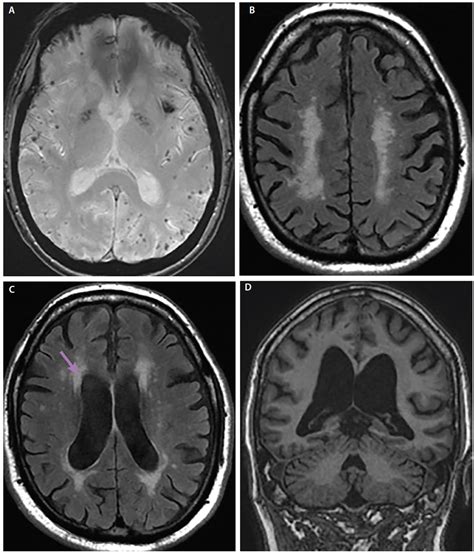 Neuroimaging And Alzheimers Disease Practical Neurology