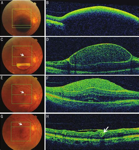Color Fundus Picture Showing Preretinal Hemorrhage And Sd Oct Scans