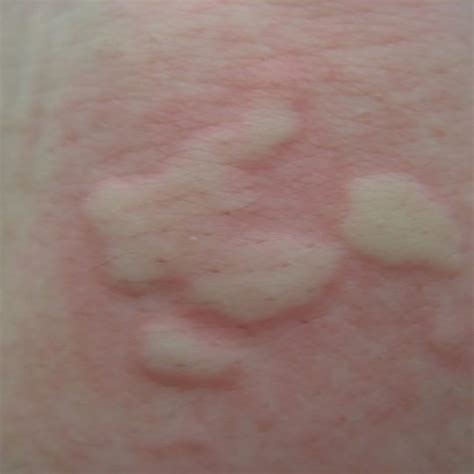 Hives As Related To Allergy Pictures
