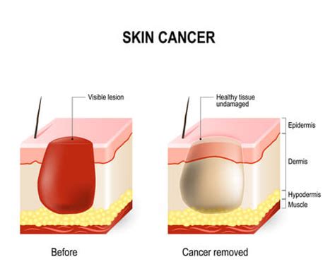 Skin Cancer Tinley Park Cancer Screening Palos Heights