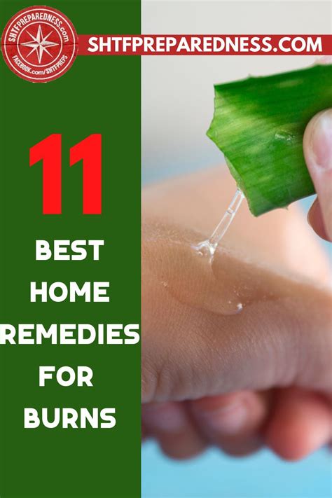 11 Best Home Remedies For Burns Recipe In 2021 Home Remedies For