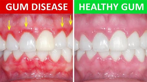 How To Get Rid Of Gingivitis At Home Gum Disease Youtube