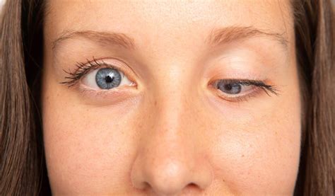 Squint Eye Surgery Strabismus Smart Laser Eye Center