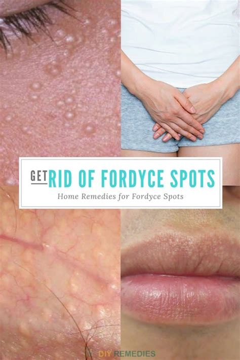 Effective Remedies To Get Rid Of Fordyce Spots