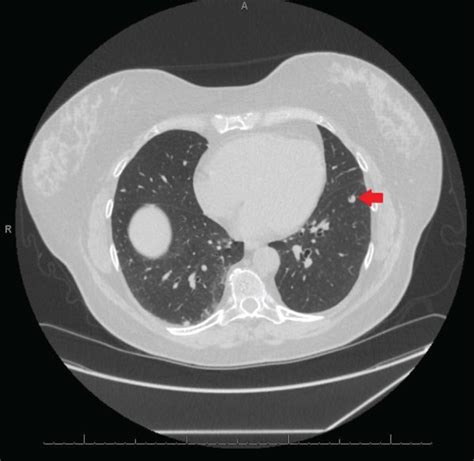 Follow Up Chest CT Scan Showing An Mm Left Lower Lobe Pulmonary