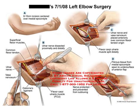 Amicus Illustration Of Amicussurgeryelbownervetranspositionfcu