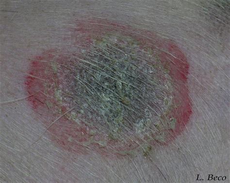 Pyoderma Bakterielle Infektionen Staphylokokken Bakterien