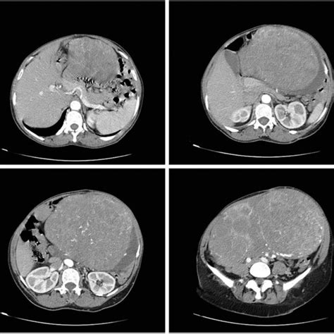 Contrast Enhanced Computed Ct Abdominal Scan Revealed An Enlarged
