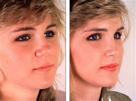 People With Big Noses Plastic Surgery Before And Afte Vrogue Co