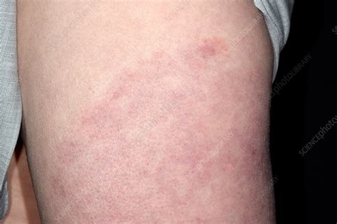 Lyme Disease Rash On Hands