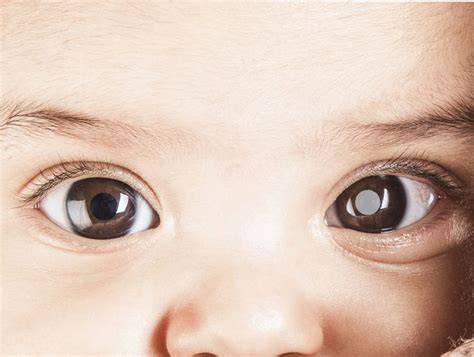 Curiosidades sobre o Retinoblastoma Prisma Visão