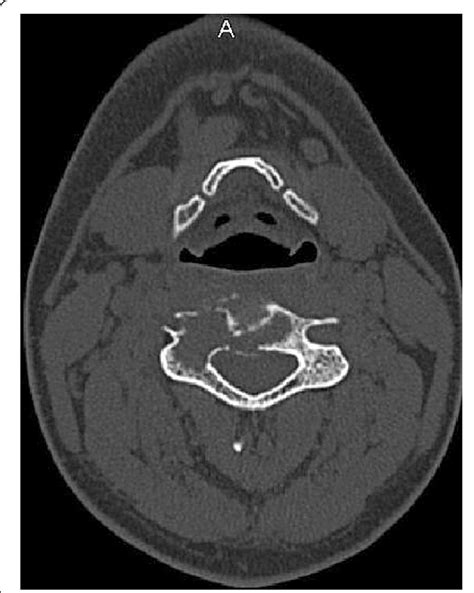 Lesion Extending From The Vertebra Corpus To The Lateral Mass On Ct In